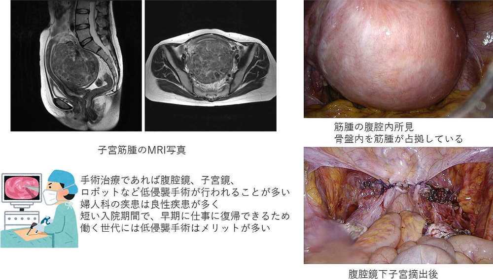 子宮筋腫のMRI写真と腹腔内所見