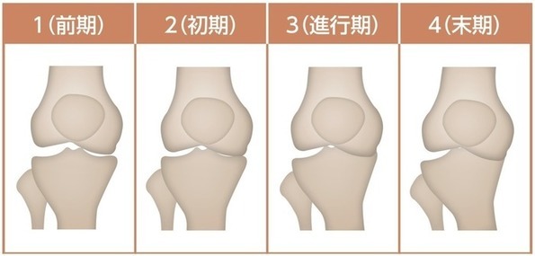 変形性膝関節症の分類 