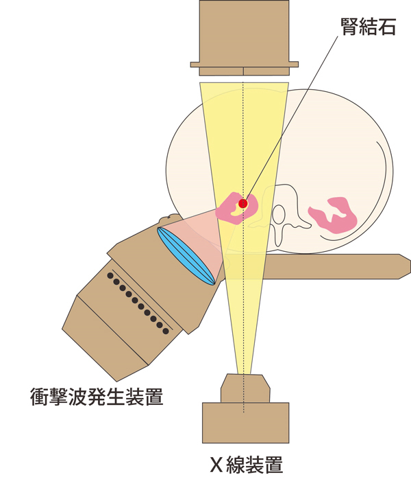 ESWL装置の仕組み図