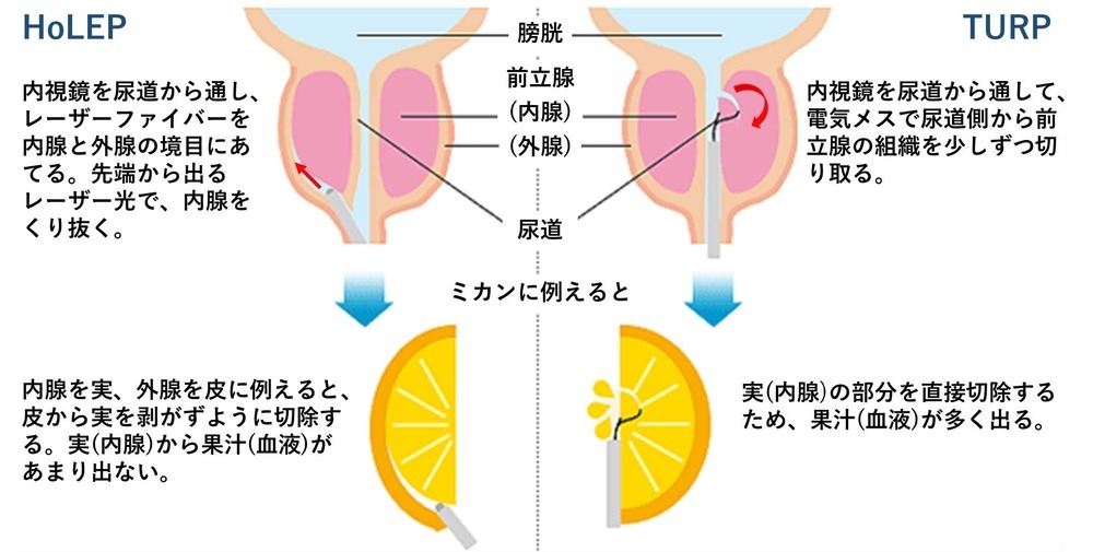 va障害のための勃起不全