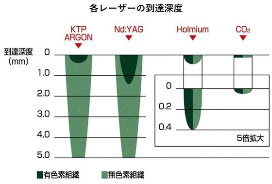 各レーザーの到達深度の図