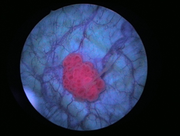 アラグリオ内服下で赤色蛍光を発する腫瘍