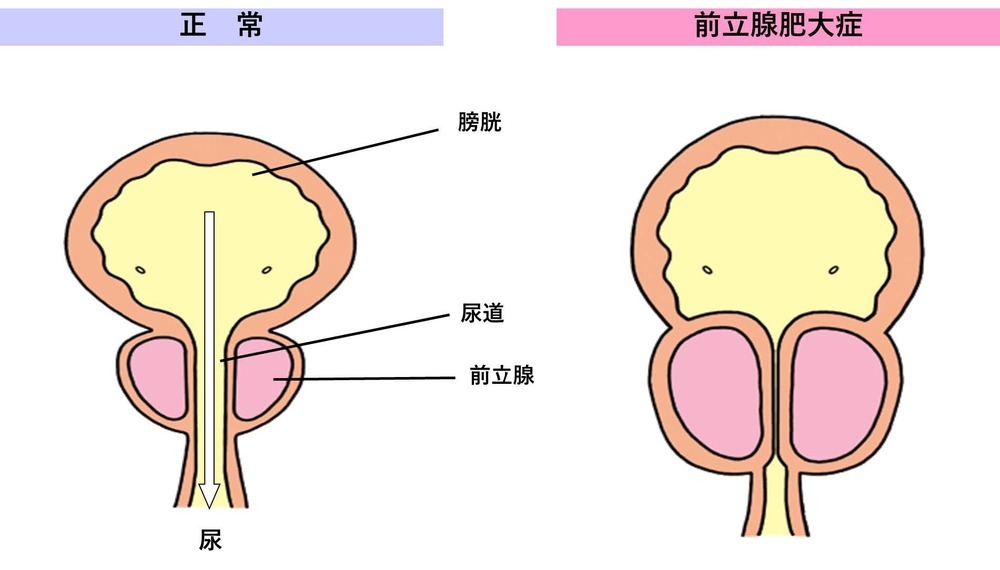 前立腺肥大症説明の図