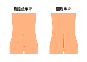 腹腔鏡手術と開腹手術の違い