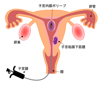 子宮鏡の図