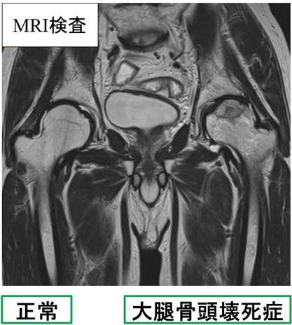 MRI検査