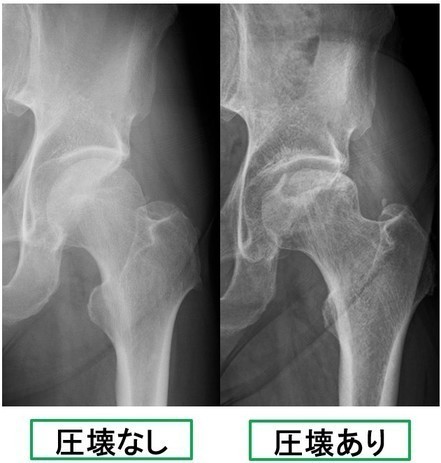 圧壊の有無の比較