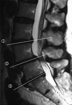 胸腰椎部側面MRI像