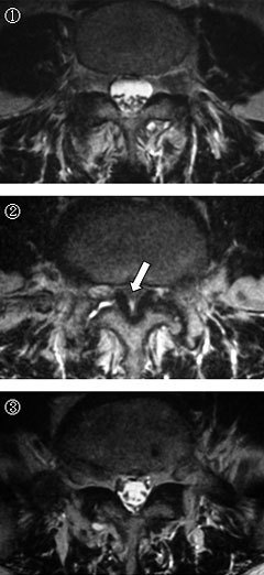 腰椎MRI横断面