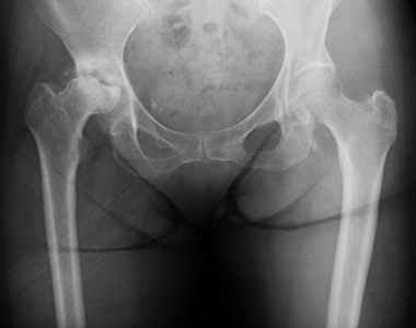 右変形性股関節症術前の様子