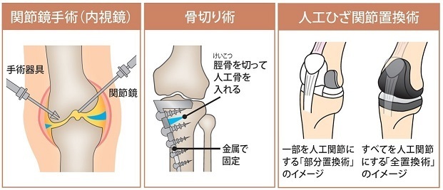 3つの手術の図