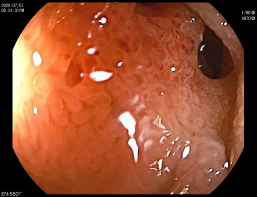 ダブルバルーン小腸内視鏡によるバルーン拡張術