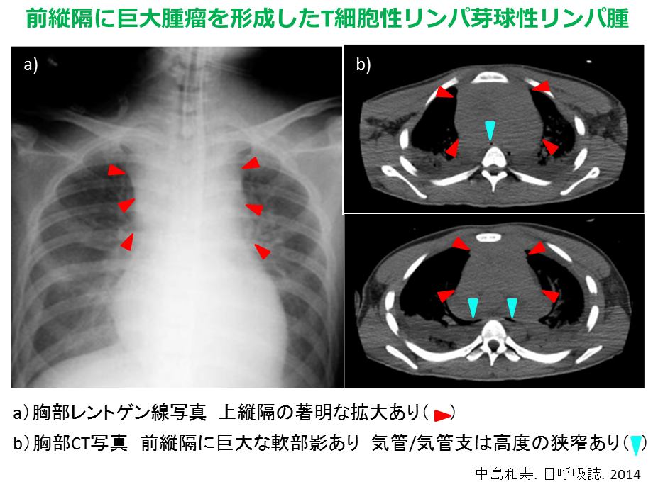 前縦隔に巨大腫瘤を形成したT細胞性リンパ芽球性リンパ腫