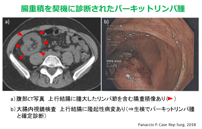 腸重積を契機に診断されたバーキットリンパ腫